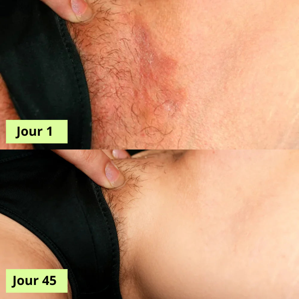 Medvital® Savon Antifongique