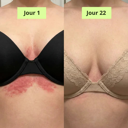 Medvital® Savon Antifongique